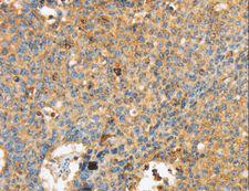 MAPK6 / ERK3 Antibody - Immunohistochemistry of paraffin-embedded Human lung cancer using MAPK6 Polyclonal Antibody at dilution of 1:40.