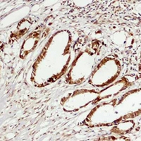 MAPK6 / ERK3 Antibody - Immunohistochemical analysis of ERK3 staining in human breast cancer formalin fixed paraffin embedded tissue section. The section was pre-treated using heat mediated antigen retrieval with sodium citrate buffer (pH 6.0). The section was then incubated with the antibody at room temperature and detected using an HRP conjugated compact polymer system. DAB was used as the chromogen. The section was then counterstained with hematoxylin and mounted with DPX.