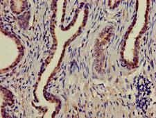 MAPK6 / ERK3 Antibody - Immunohistochemistry of paraffin-embedded human prostate cancer at dilution of 1:100
