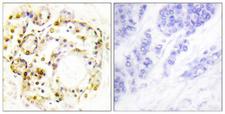 MAPK6 / ERK3 Antibody - Immunohistochemistry analysis of paraffin-embedded human breast carcinoma, using ERK3 (Phospho-Ser189) Antibody. The picture on the right is blocked with the phospho peptide.