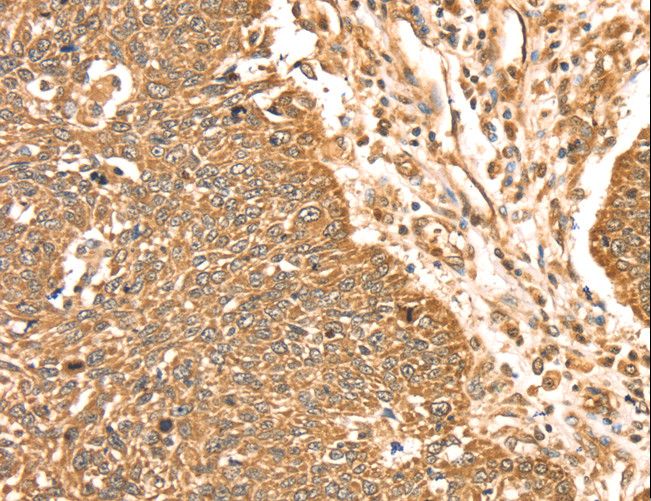 MAPK7 / ERK5 Antibody - Immunohistochemistry of paraffin-embedded Human lung cancer using MAPK7 Polyclonal Antibody at dilution of 1:35.