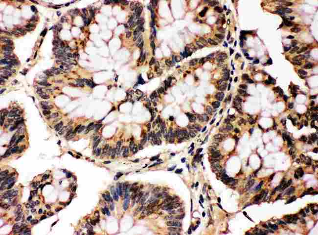 MAPK8 / JNK1 Antibody - Anti-MAPK8/9 antibody, IHC(P): Human Intestinal Cancer Tissue