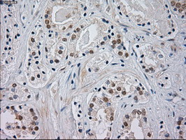 MAPK8 / JNK1 Antibody - IHC of paraffin-embedded Carcinoma of Human prostate tissue using anti-JNK1 mouse monoclonal antibody.