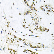 MAPK8 / JNK1 Antibody - Immunohistochemistry of paraffin-embedded human gastric cancer using MAPK8 antibodyat dilution of 1:100 (40x lens).