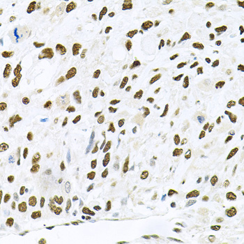 MAPK8 / JNK1 Antibody - Immunohistochemistry of paraffin-embedded human lung cancer using MAPK8 antibodyat dilution of 1:100 (40x lens).