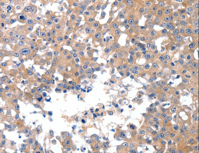 MAPK8 / JNK1 Antibody - Immunohistochemistry of paraffin-embedded Human breast cancer using MAPK8 Polyclonal Antibody at dilution of 1:50.