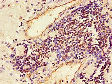 MAPK8 / JNK1 Antibody - Immunohistochemistry of paraffin-embedded human prostate cancer using MAPK8 Antibody at dilution of 1:100
