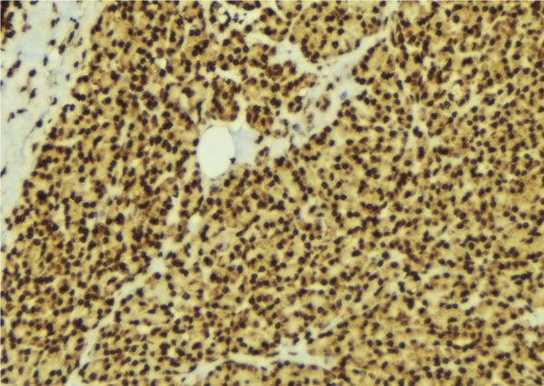 MAPK8 / JNK1 Antibody - 1:100 staining human breast carcinoma tissue by IHC-P. The sample was formaldehyde fixed and a heat mediated antigen retrieval step in citrate buffer was performed. The sample was then blocked and incubated with the antibody for 1.5 hours at 22°C. An HRP conjugated goat anti-rabbit antibody was used as the secondary.