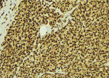 MAPK8 / JNK1 Antibody - 1:100 staining human breast carcinoma tissue by IHC-P. The sample was formaldehyde fixed and a heat mediated antigen retrieval step in citrate buffer was performed. The sample was then blocked and incubated with the antibody for 1.5 hours at 22°C. An HRP conjugated goat anti-rabbit antibody was used as the secondary.