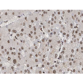 MAPK8 / JNK1 Antibody - 1:200 staining human liver carcinoma tissues by IHC-P. The tissue was formaldehyde fixed and a heat mediated antigen retrieval step in citrate buffer was performed. The tissue was then blocked and incubated with the antibody for 1.5 hours at 22°C. An HRP conjugated goat anti-rabbit antibody was used as the secondary.