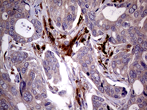 MAPK8IP1 / JIP1 Antibody - Immunohistochemical staining of paraffin-embedded Adenocarcinoma of Human breast tissue tissue using anti-MAPK8IP1 mouse monoclonal antibody. (Heat-induced epitope retrieval by 1mM EDTA in 10mM Tris buffer. (pH8.5) at 120°C for 3 min. (1:150)