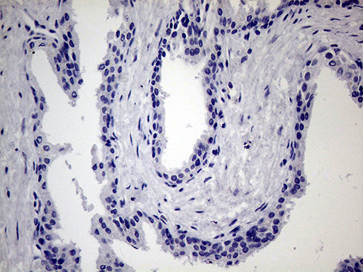 MAPK8IP1 / JIP1 Antibody - Immunohistochemical staining of paraffin-embedded Carcinoma of Human prostate tissue using anti-MAPK8IP1 mouse monoclonal antibody. This figure shows negative staining. (Heat-induced epitope retrieval by 1mM EDTA in 10mM Tris buffer. (pH8.5) at 120°C for 3 min. (1:150)