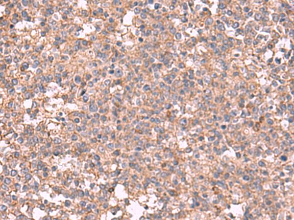 MAPK8IP3 / JIP3 Antibody - Immunohistochemistry of paraffin-embedded Human tonsil tissue  using MAPK8IP3 Polyclonal Antibody at dilution of 1:45(×200)