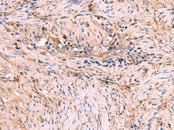 MAPK8IP3 / JIP3 Antibody - Immunohistochemistry of paraffin-embedded Human cervical cancer tissue  using MAPK8IP3 Polyclonal Antibody at dilution of 1:45(×200)