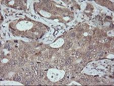 MAPK9 / JNK2 Antibody - IHC of paraffin-embedded Adenocarcinoma of Human breast tissue using anti-MAPK9 mouse monoclonal antibody.