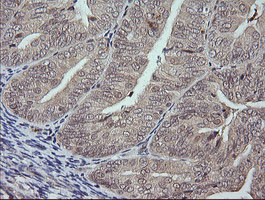 MAPK9 / JNK2 Antibody - IHC of paraffin-embedded Adenocarcinoma of Human endometrium tissue using anti-MAPK9 mouse monoclonal antibody.