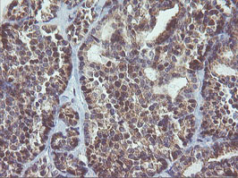 MAPK9 / JNK2 Antibody - IHC of paraffin-embedded Carcinoma of Human thyroid tissue using anti-MAPK9 mouse monoclonal antibody.