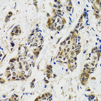 MAPK9 / JNK2 Antibody - Immunohistochemistry of paraffin-embedded human breast cancer using MAPK9 antibodyat dilution of 1:100 (40x lens).
