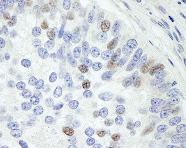 MAPKAP1 / MIP1 Antibody - Detection of Human Sin1 by Immunohistochemistry. Sample: FFPE section of human prostate adenocarcinoma. Antibody: Affinity purified rabbit anti-Sin1 used at a dilution of 1:500.