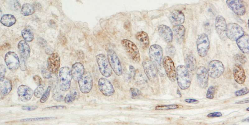 MAPKAP1 / MIP1 Antibody - Detection of Human Sin1 by Immunohistochemistry. Sample: FFPE section of human prostate carcinoma. Antibody: Affinity purified rabbit anti-Sin1 used at a dilution of 1:1000 (1 ug/ml). Detection: DAB.