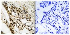 MAPKAPK2 / MAPKAP Kinase 2 Antibody - Immunohistochemistry analysis of paraffin-embedded human breast carcinoma tissue, using MAPKAPK2 Antibody. The picture on the right is blocked with the synthesized peptide.