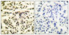 MAPKAPK2 / MAPKAP Kinase 2 Antibody - Immunohistochemistry analysis of paraffin-embedded human breast carcinoma tissue, using MAPKAPK2 Antibody. The picture on the right is blocked with the synthesized peptide.