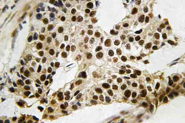 MAPKAPK2 / MAPKAP Kinase 2 Antibody - IHC of MAPKAPK-2 (N266) pAb in paraffin-embedded human breast carcinoma tissue.