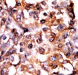 MAPKAPK2 / MAPKAP Kinase 2 Antibody - Formalin-fixed and paraffin-embedded human cancer tissue reacted with the primary antibody, which was peroxidase-conjugated to the secondary antibody, followed by AEC staining. This data demonstrates the use of this antibody for immunohistochemistry; clinical relevance has not been evaluated. BC = breast carcinoma; HC = hepatocarcinoma.