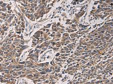 MAPKAPK3 Antibody - Immunohistochemistry of paraffin-embedded Human colorectal cancer tissue  using MAPKAPK3 Polyclonal Antibody at dilution of 1:95(×200)