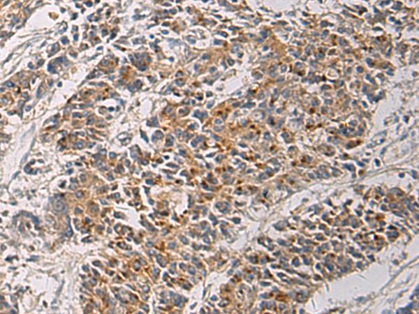 MAPKAPK3 Antibody - Immunohistochemistry of paraffin-embedded Human colorectal cancer tissue  using MAPKAPK3 Polyclonal Antibody at dilution of 1:60(×200)