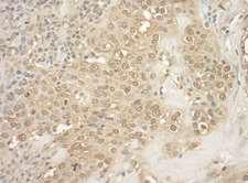 MAPKAPK5 / PRAK Antibody - Detection of Human MK5 by Immunohistochemistry. Sample: FFPE section of human breast carcinoma. Antibody: Affinity purified rabbit anti-MK5 used at a dilution of 1:200 (1 Detection: DAB.