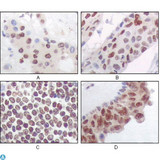 MAPKAPK5 / PRAK Antibody - Immunohistochemistry (IHC) analysis of paraffin-embedded Human Liver Carcinoma (A), esophagus carcinoma (B), normal spleen tissue(C), breast carcinoma (D), showing nuclear and cytoplasmic localization with DAB staining using PRAK Monoclonal Antibody.