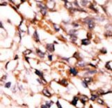 MAPKAPK5 / PRAK Antibody - Formalin-fixed and paraffin-embedded human cancer tissue reacted with the primary antibody, which was peroxidase-conjugated to the secondary antibody, followed by DAB staining. This data demonstrates the use of this antibody for immunohistochemistry; clinical relevance has not been evaluated. BC = breast carcinoma; HC = hepatocarcinoma.