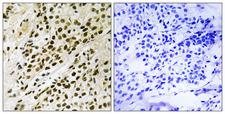 MAPKAPK5 / PRAK Antibody - Immunohistochemistry analysis of paraffin-embedded human breast carcinoma, using MAPKAPK5 (Phospho-Thr182) Antibody. The picture on the right is blocked with the phospho peptide.