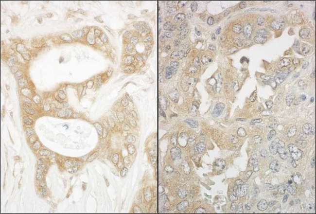 MAPRE1 / EB1 Antibody - Detection of Human and Mouse EB1 by Immunohistochemistry. Sample: FFPE section of human ovarian carcinoma (left) and mouse teratoma (right). Antibody: Affinity purified rabbit anti-EB1 used at a dilution of 1:200 (1 Detection: DAB.