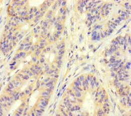 MAPRE1 / EB1 Antibody - Immunohistochemistry of paraffin-embedded human colon cancer using MAPRE1 Antibody at dilution of 1:100
