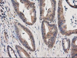 MAPRE2 / EB2 Antibody - IHC of paraffin-embedded Adenocarcinoma of Human colon tissue using anti-MAPRE2 mouse monoclonal antibody.