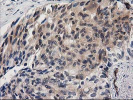 MAPRE2 / EB2 Antibody - IHC of paraffin-embedded Carcinoma of Human lung tissue using anti-MAPRE2 mouse monoclonal antibody.