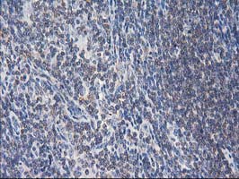 MAPRE2 / EB2 Antibody - IHC of paraffin-embedded Human lymphoma tissue using anti-MAPRE2 mouse monoclonal antibody.
