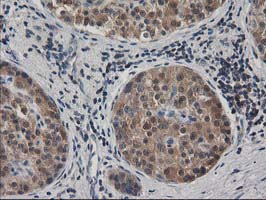 MAPRE2 / EB2 Antibody - IHC of paraffin-embedded Carcinoma of Human pancreas tissue using anti-MAPRE2 mouse monoclonal antibody.