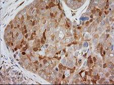 MAPRE2 / EB2 Antibody - IHC of paraffin-embedded Adenocarcinoma of Human breast tissue using anti-MAPRE2 mouse monoclonal antibody.