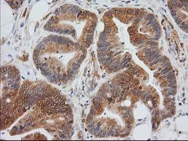 MAPRE2 / EB2 Antibody - IHC of paraffin-embedded Adenocarcinoma of Human colon tissue using anti-MAPRE2 mouse monoclonal antibody.