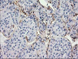 MAPRE2 / EB2 Antibody - IHC of paraffin-embedded Carcinoma of Human liver tissue using anti-MAPRE2 mouse monoclonal antibody.