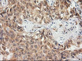 MAPRE2 / EB2 Antibody - IHC of paraffin-embedded Carcinoma of Human lung tissue using anti-MAPRE2 mouse monoclonal antibody.
