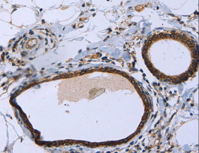MAPRE3 / EB3 Antibody - Immunohistochemistry of paraffin-embedded Human breast cancer using MAPRE3 Polyclonal Antibody at dilution of 1:20.