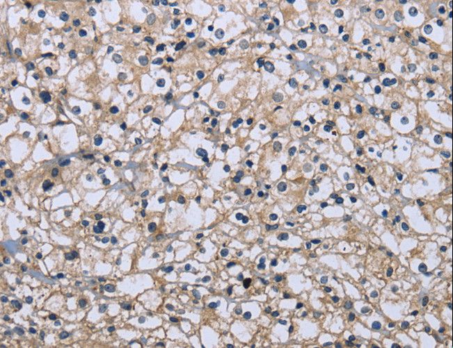 MAPRE3 / EB3 Antibody - Immunohistochemistry of paraffin-embedded Human prostate cancer using MAPRE3 Polyclonal Antibody at dilution of 1:20.