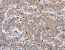 MAPRE3 / EB3 Antibody - Immunohistochemistry of paraffin-embedded Human liver cancer using ECE1 Polyclonal Antibody at dilution of 1:30.