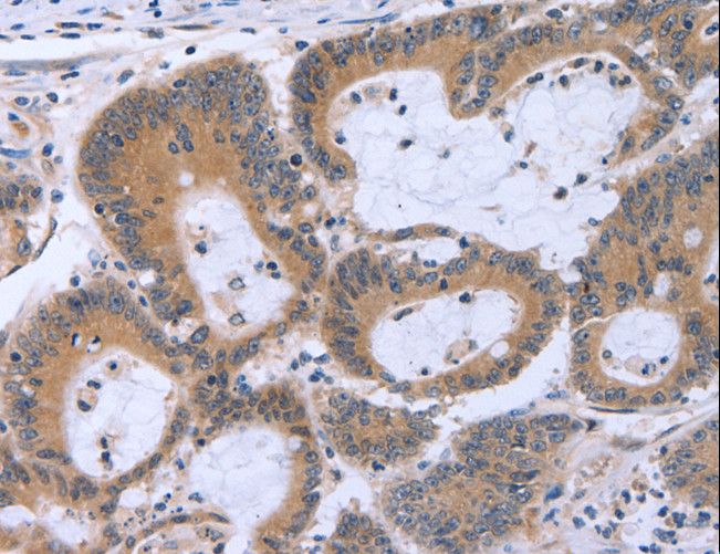MAPRE3 / EB3 Antibody - Immunohistochemistry of paraffin-embedded Human colon cancer using ECE1 Polyclonal Antibody at dilution of 1:30.