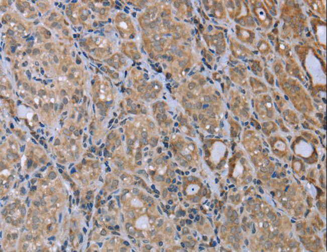 MAPRE3 / EB3 Antibody - Immunohistochemistry of paraffin-embedded Human thyroid cancer using MAPRE3 Polyclonal Antibody at dilution of 1:20.