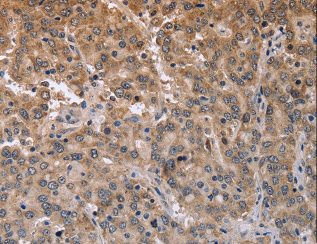 MAPRE3 / EB3 Antibody - Immunohistochemistry of paraffin-embedded Human liver cancer using ECE1 Polyclonal Antibody at dilution of 1:50.